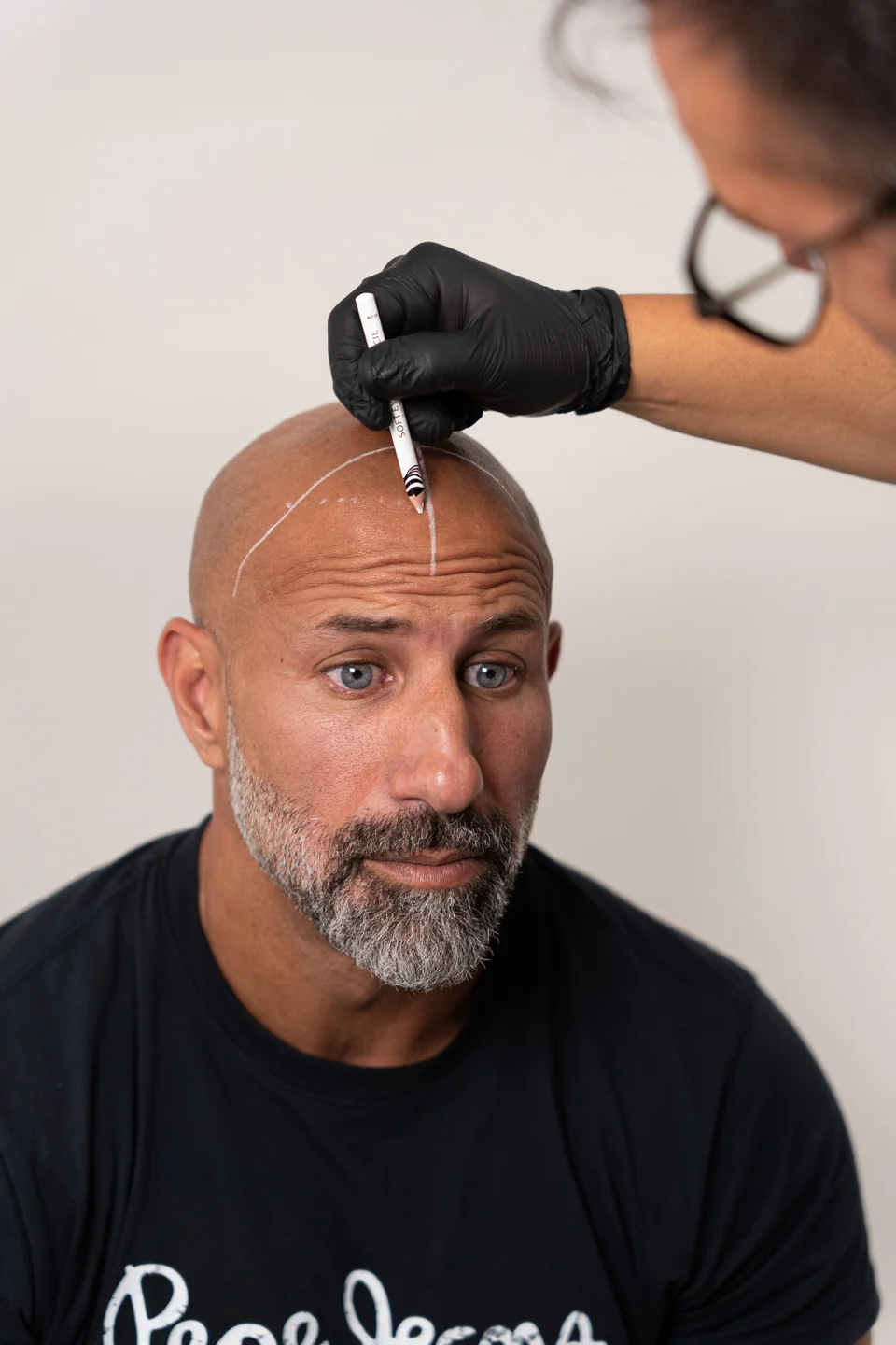 Profesional de Centro MEI dibujando la línea frontal antes de una micropigmentación capilar